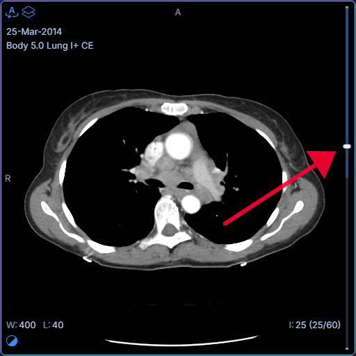 viewportScrollbar.variant: progress (default)